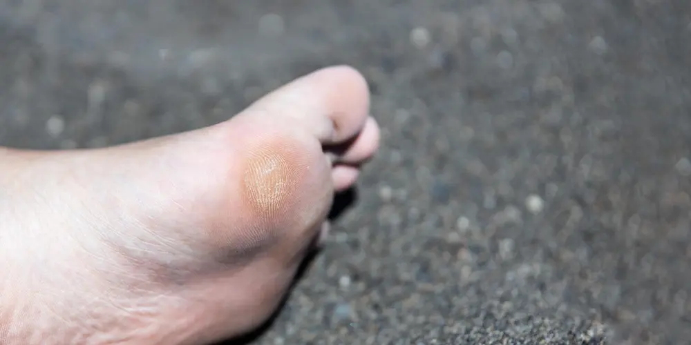 early-stage-diabetic-foot-ulcer