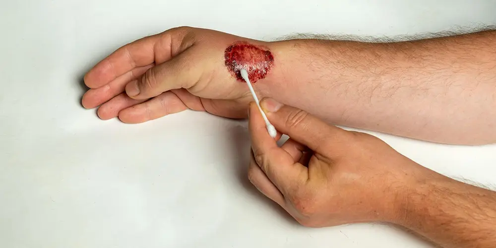 Slough Wound