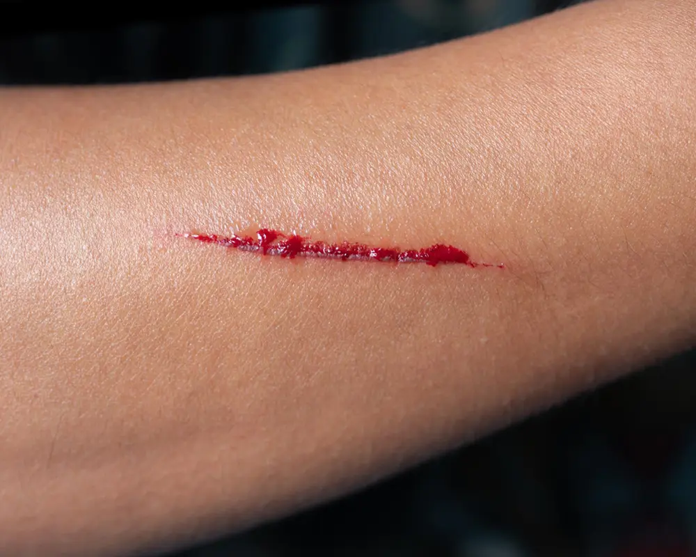 Laceration Wound