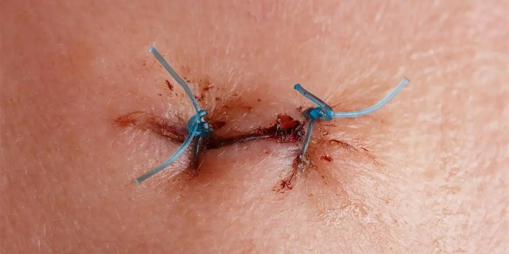 Tunneling Wounds