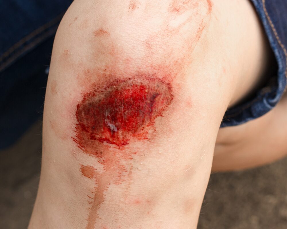 Infected Wound