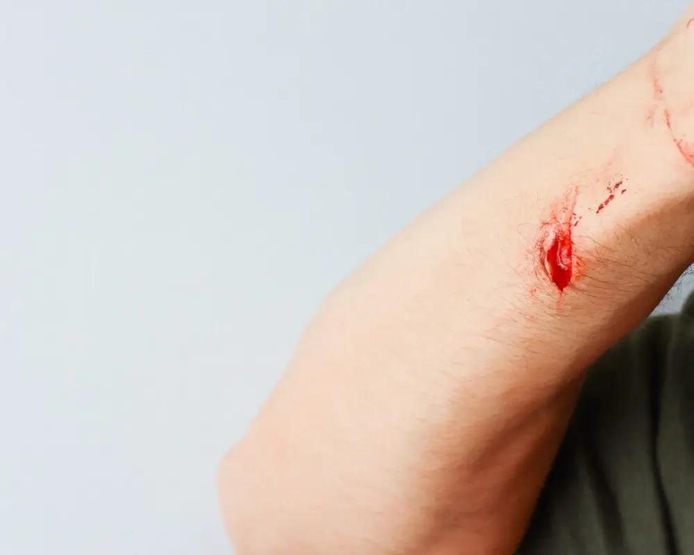 Open Wound