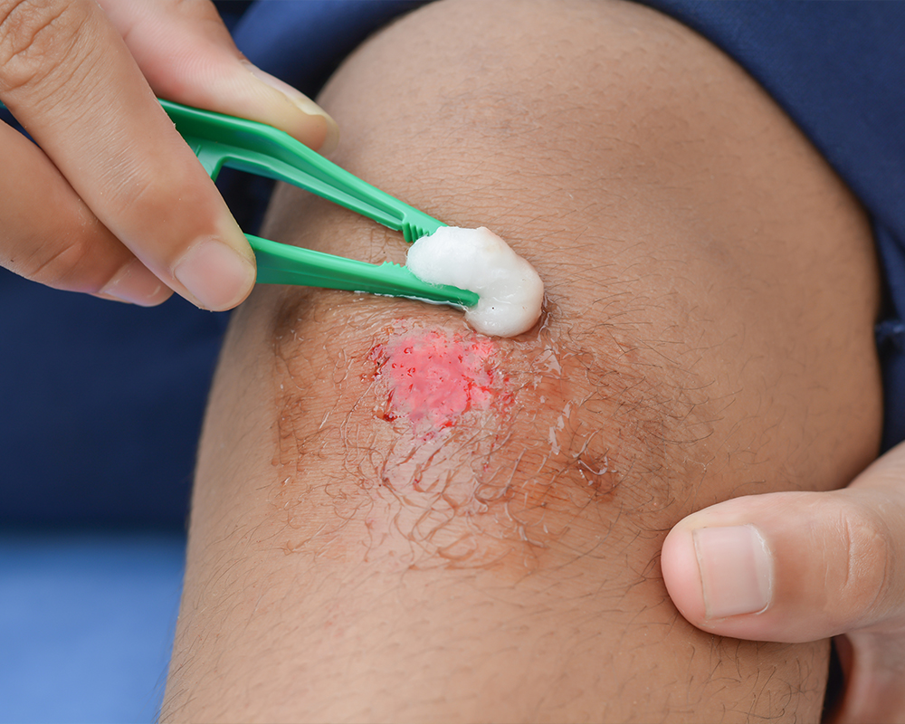 Denuded Wound