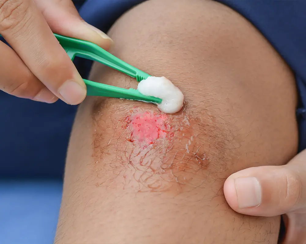 Denuded Wound