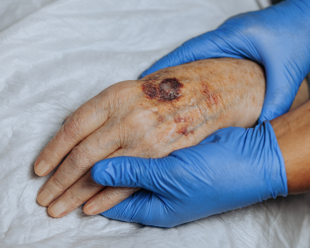 Chronic Wounds