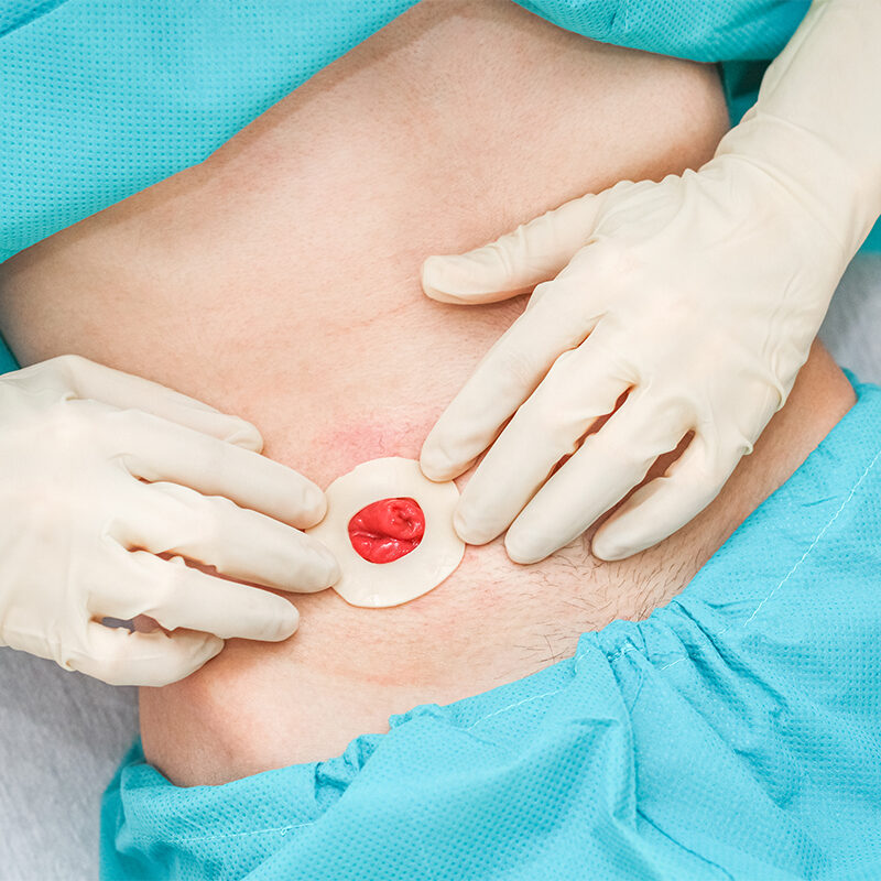 Sacral Wound