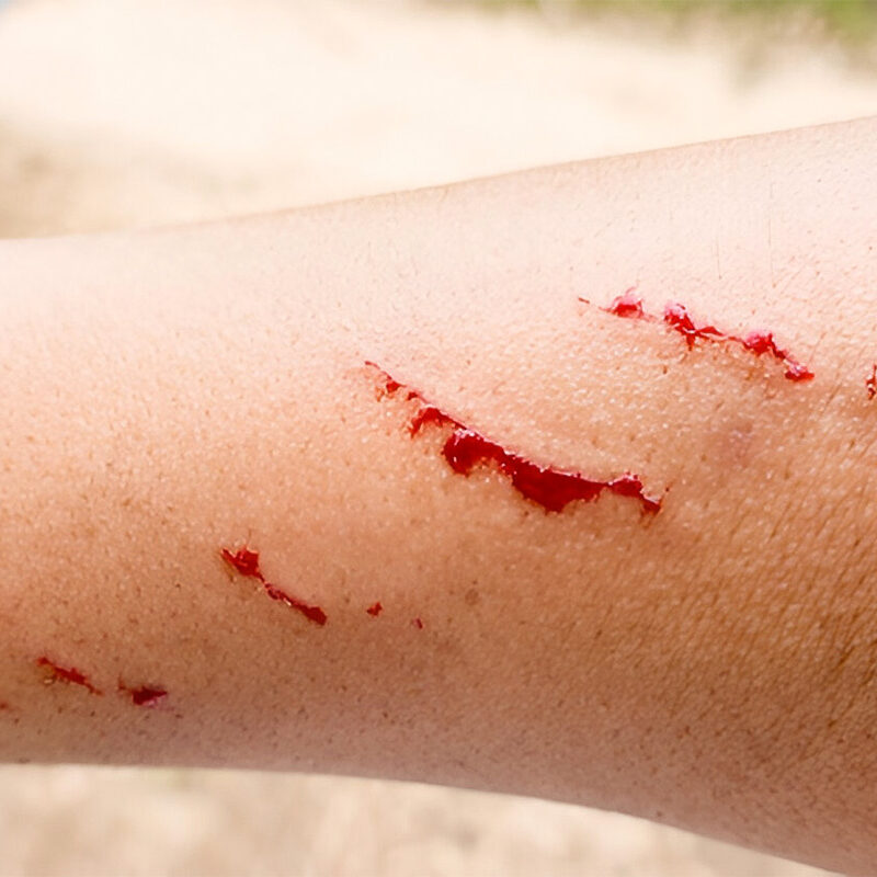 Stab Wound
