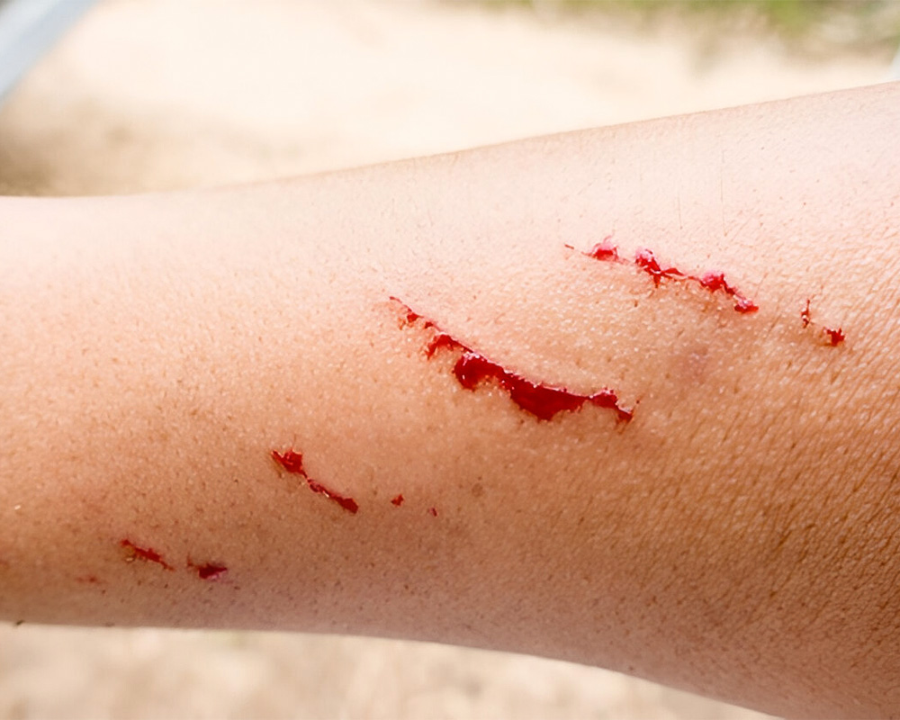 Stab Wound